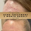 Acne Treatment Wilmslow Dr Sknn Before & After Picture