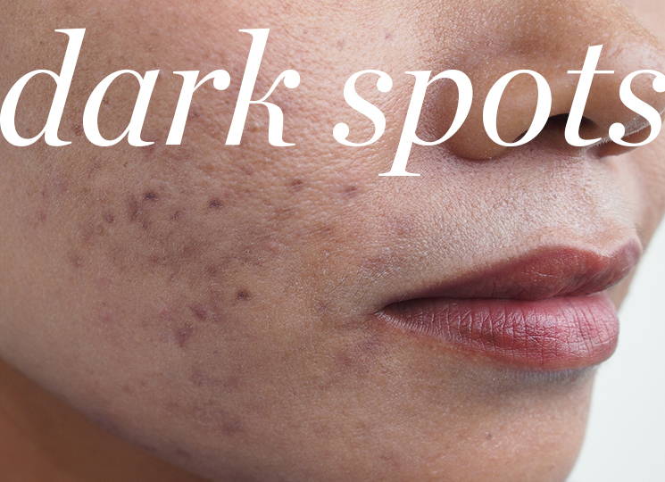 Woman's With Dark Spots on Face - Link to Dark Spots Section of Same Page