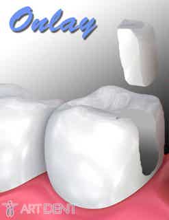 Onlay illustration-onlay