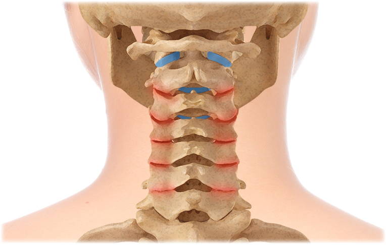 Osteoarthritis (Spondylosis) Illustration