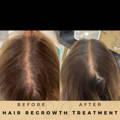 Hair Loss Treatment Dr Sknn Before & After Picture