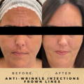 Frown Line Anti-Wrinkle Injections Wilmslow