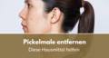 Pickelmale entfernen 