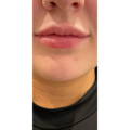 Dermal Fillers - Lip Fillers - Before