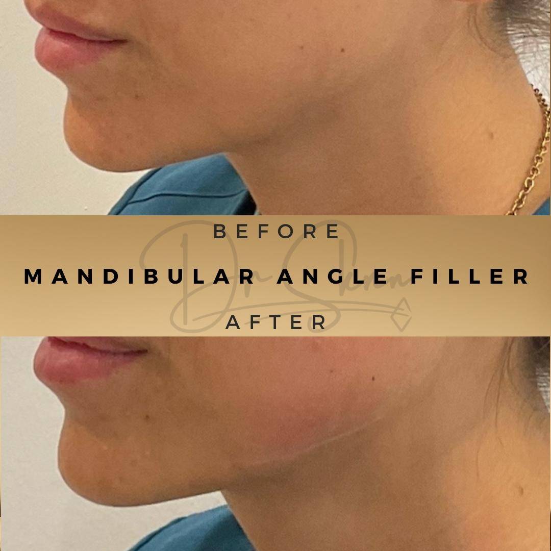 Jawline Fillers - Dr Sknn before and after