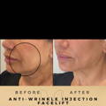 Liquid Facelift Wilmslow with Anti-wrinkle injections