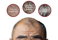 An image showing a balding man's head with close-ups of his scalp issues: thin and fragile hair, dead skin and sebum buildup, and a hot scalp. They need hair tonic to nourish and strengthen the follicles.