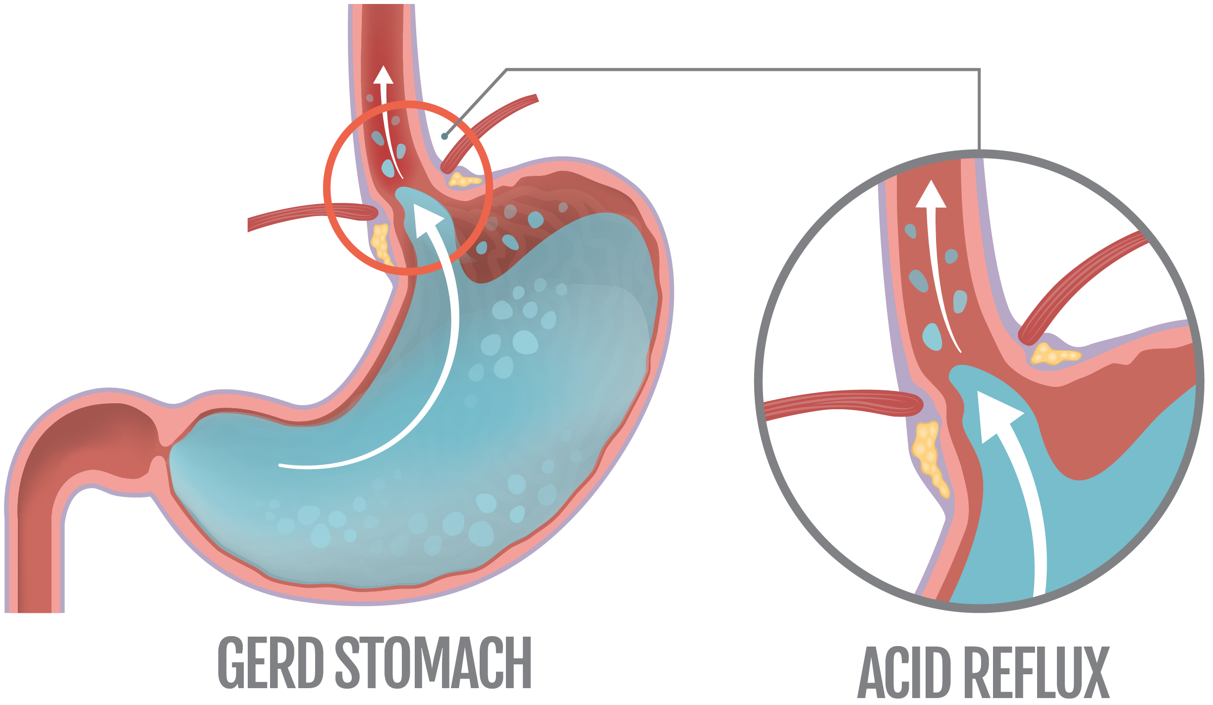 Acid Reflux Aspiration What Causes Aspiration In Women IVMR