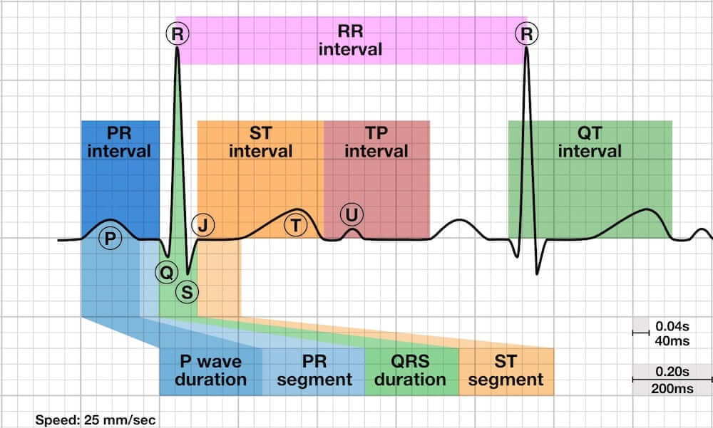 P Wave, Characteristics of the respiratory sinus arrhythmia P Wave, Respiratory sinus arrhythmia 