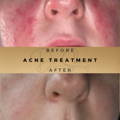 IPL Acne Treatment Wilmslow Dr Sknn Before & After Picture