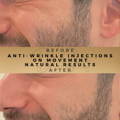 Smile Lines Anti-Wrinkle Injections Wilmslow