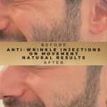 Smile Lines Anti-Wrinkle Injections Wilmslow