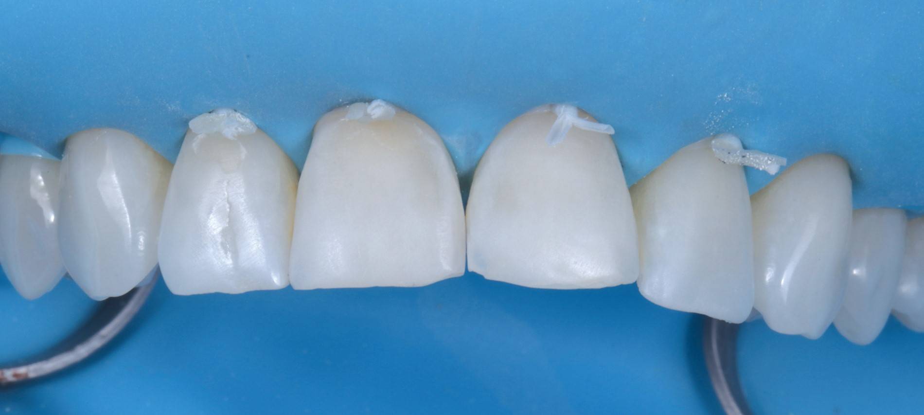Patients upper teeth isolated by blue rubber dam