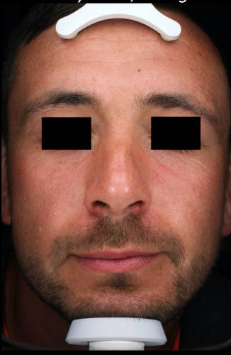Dr Sknn Personalised Serum Microneedling - Custom Mesotherapy Before