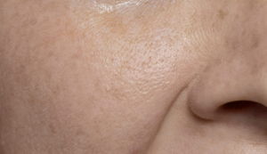 Skin Tightening (Dermalogica Pro Firm)