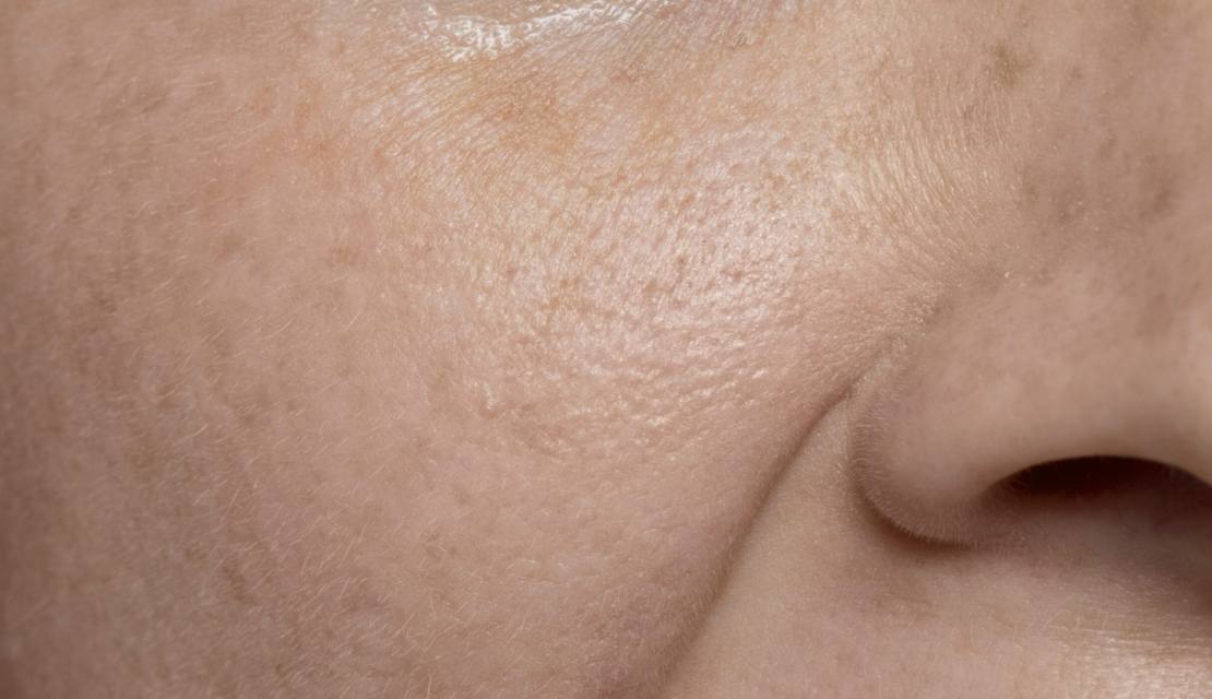 Skin Tightening (Dermalogica Pro Firm)