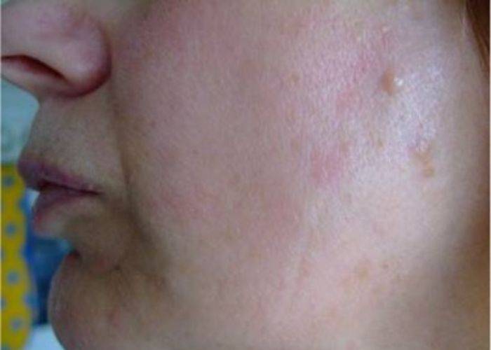Intense Pulsed Light Vascular lesions After