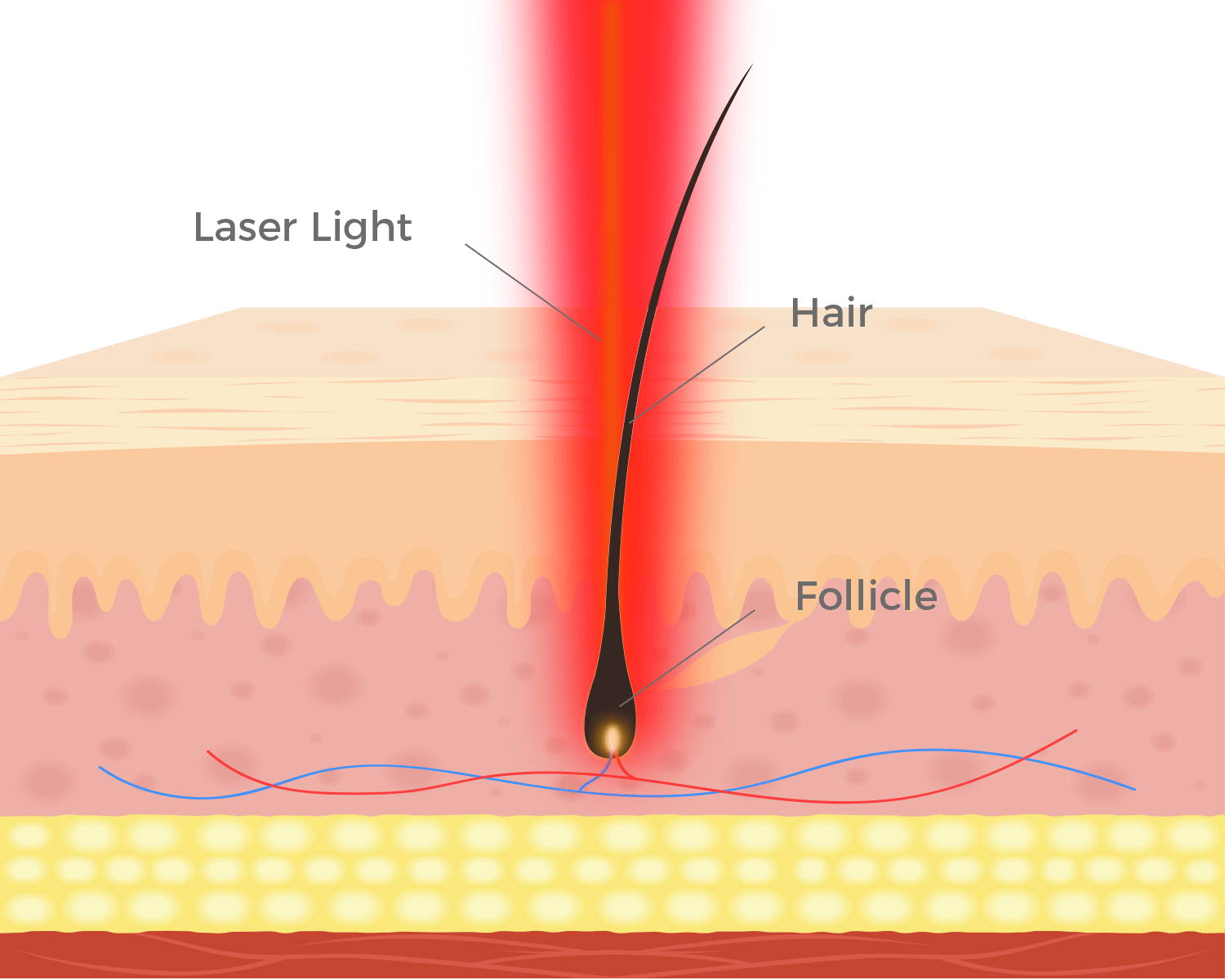 Laser in Hair Growth Devices Laser in Hair Growth Devices