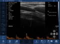 EagleView handheld ultrasound shows measured velocity using pulsed wave doppler.