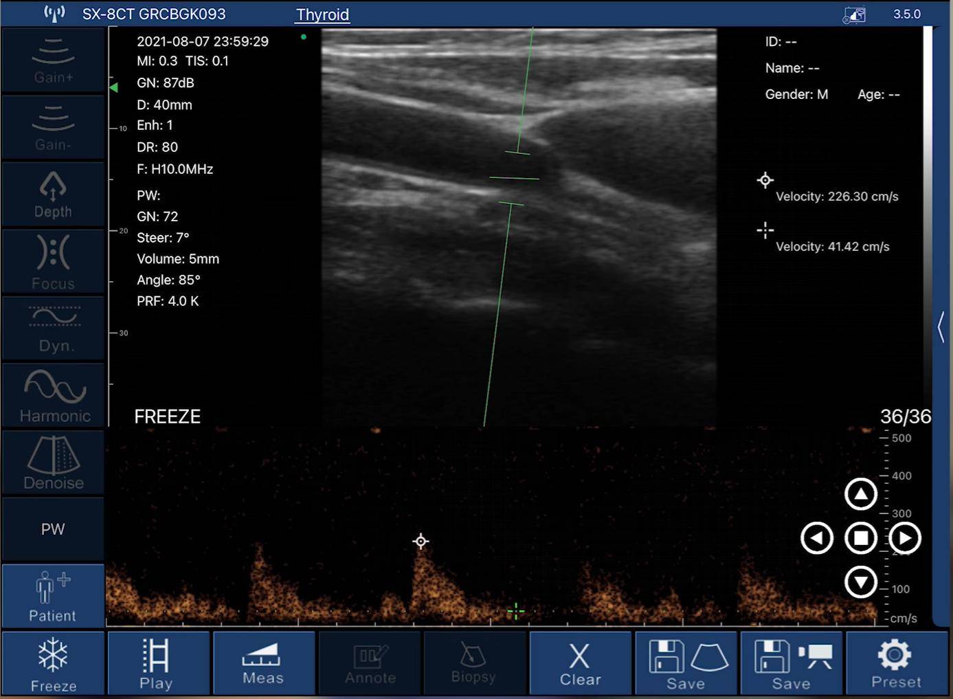 EagleView handheld ultrasound shows measured velocity using pulsed wave doppler.