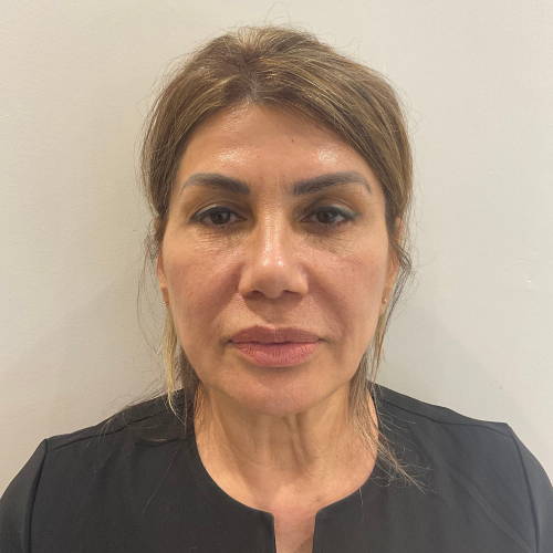 Dr Sknn Cheek, Nasolabial & Jowl Dermal Fillers Before
