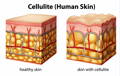 side by side diagrams of the human skin - comparing healthy skin with enough collagen and skin with cellulite, lacking in collagen
