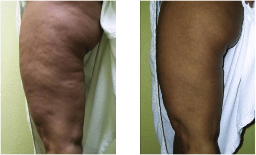 Before-left-and-after-right-one-treatment-in-the-buttocks-with-1440-nm-Cellulaze.png