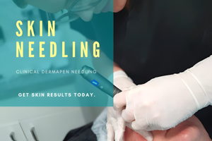 Lovely Skin and Beauty - Skin Needling – Face & Neck