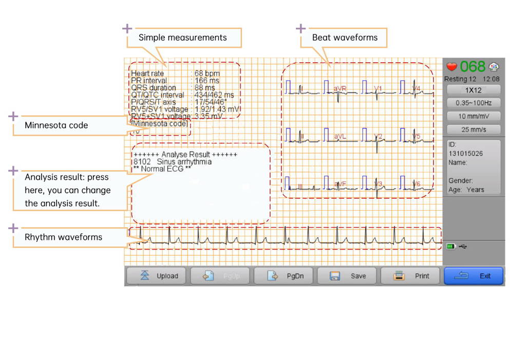 The ECG machine automatically interpretates waveforms based on the Biocare CardioProTM ECG analysis program, proven by CSE, AHA, MIT databases.