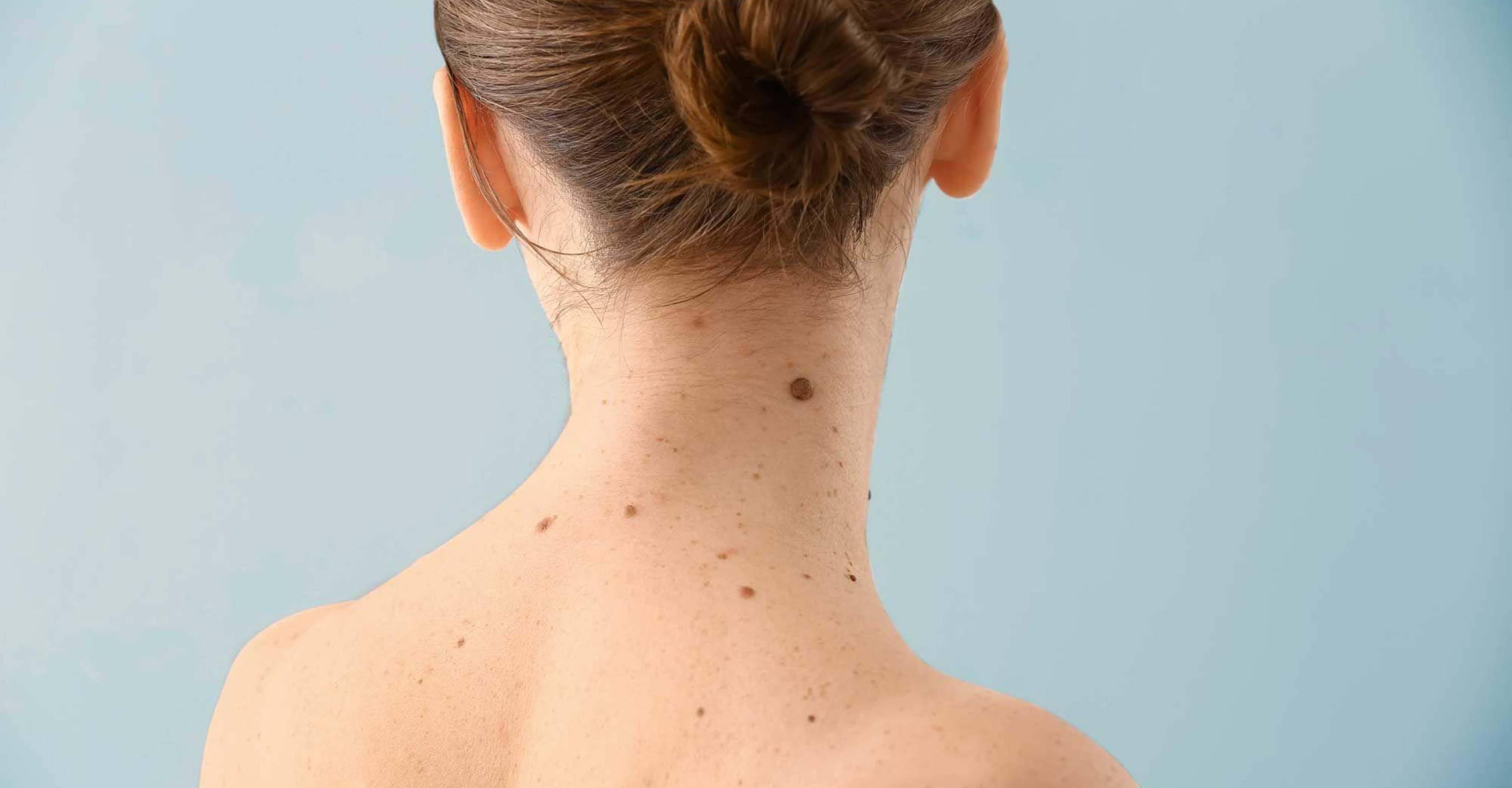 Skin tags on the neck