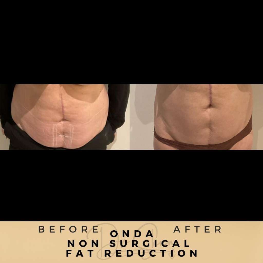Non Surgical Fat Reduction Wilmslow Before & After Dr Sknn ONDA