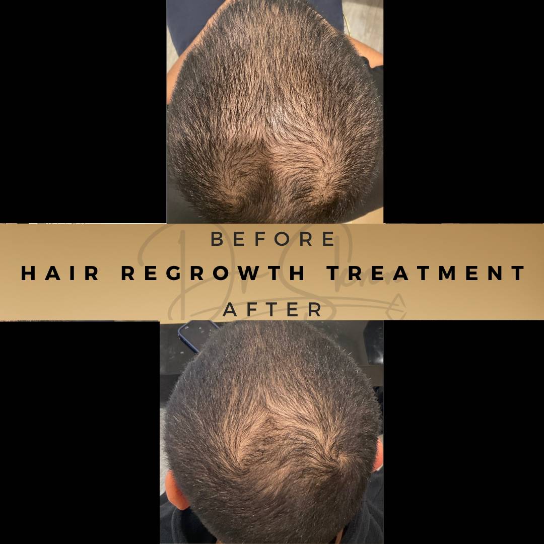 Hair Loss Treatment