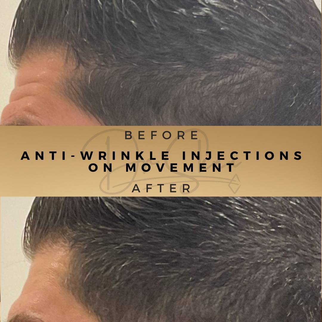 Anti-Wrinkle Injections Wilmslow Before & After Dr Sknn