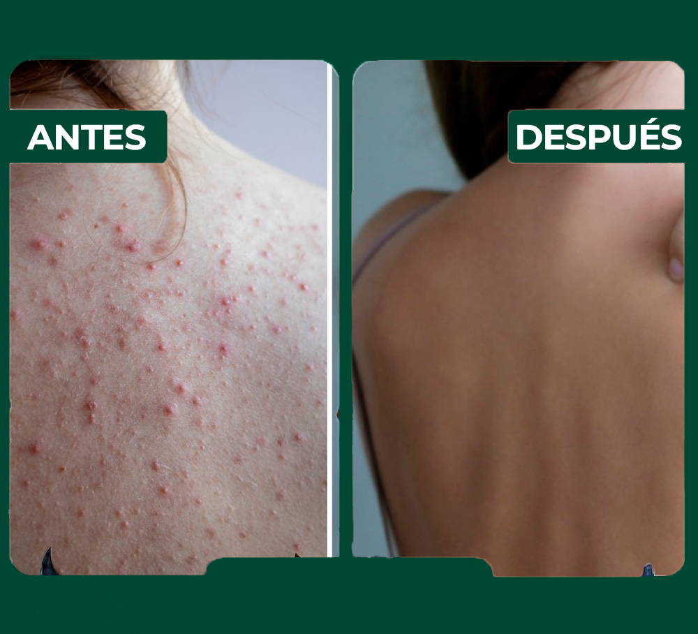 Aerosol para tratamiento en la espalda MEDix Beauty Secret