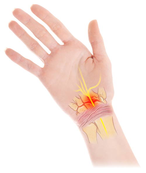 CARPAL TUNNEL SYNDROME ILLUSTRATION