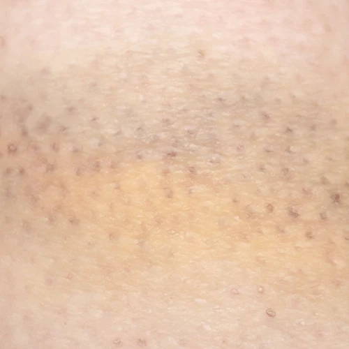 Bruise healing progress after three treatments with a laser pain relief device