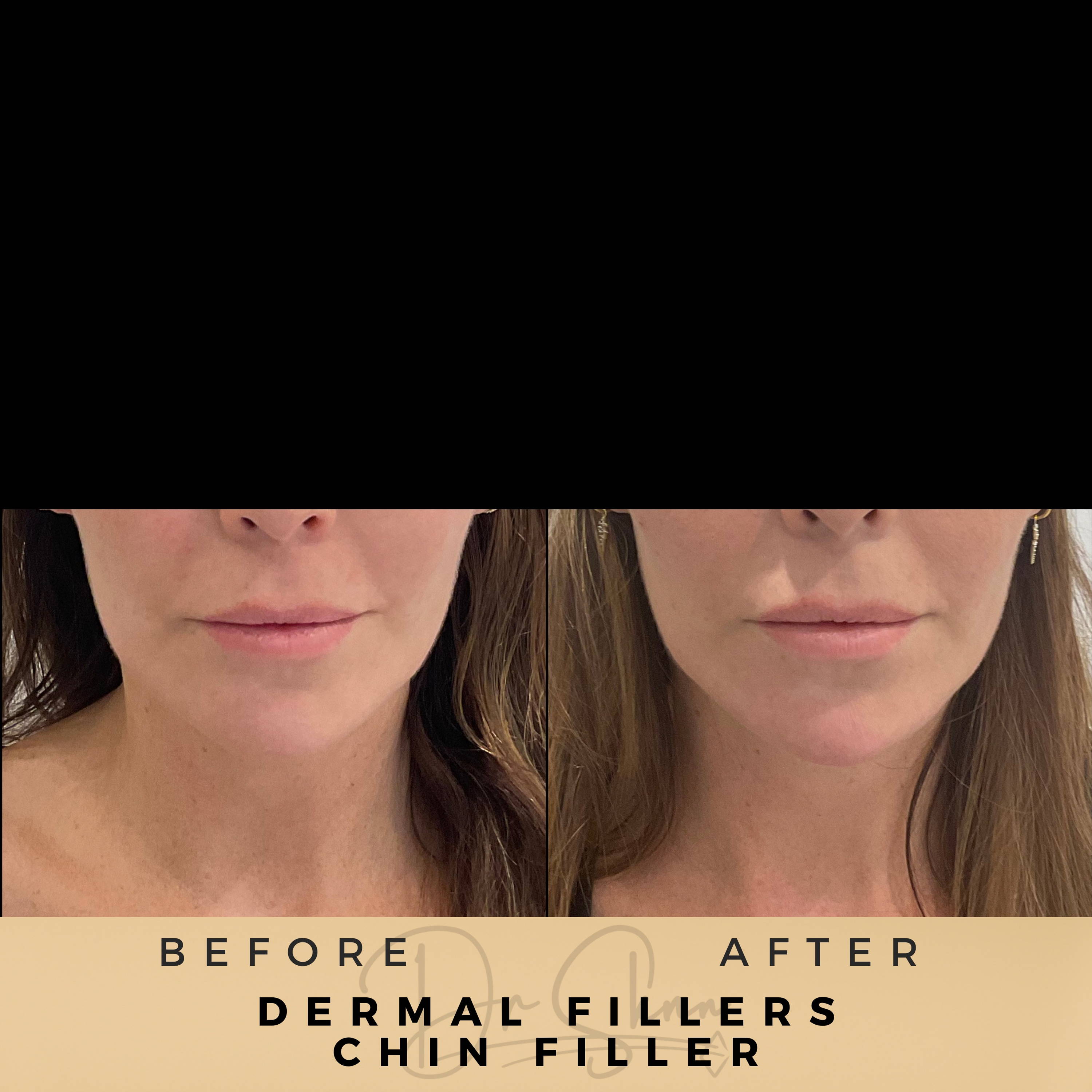Chin Fillers - Dr Sknn before and after