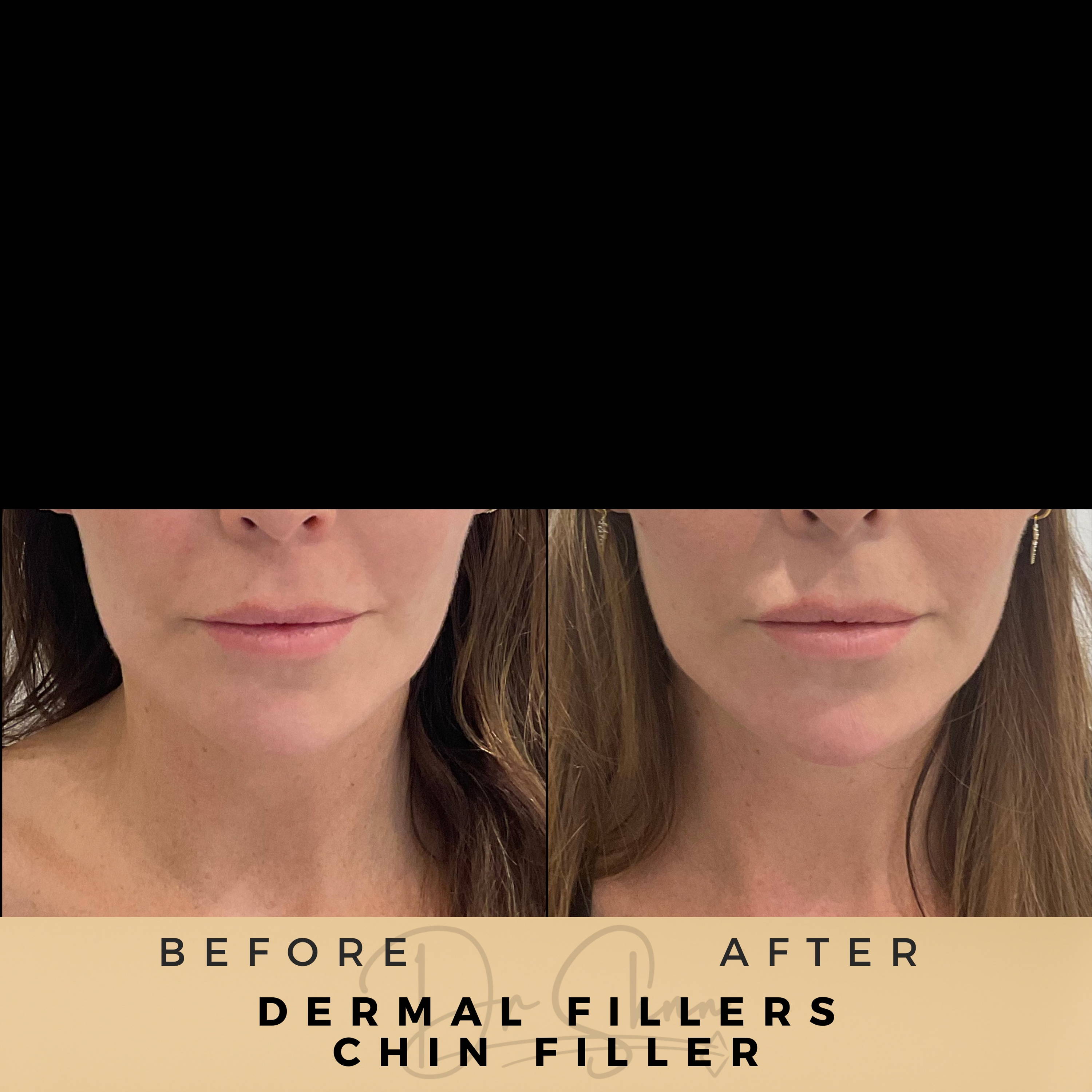 Chin Fillers Wilmslow Before & After Dr Sknn