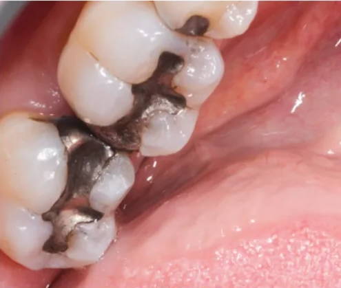 molars showing old amalgam restoration