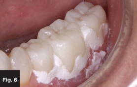 the excess cement around seated monolithic zirconia crown