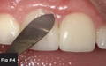 After the application of MPa Max Maximum Performance Adhesive (Clinician’s Choice®), it was dried and cured. Evanesce shade B-1 (Clinician’s Choice®) was then applied and contoured with the Esthetic Contouring Instrument (Clinician’s Choice®)