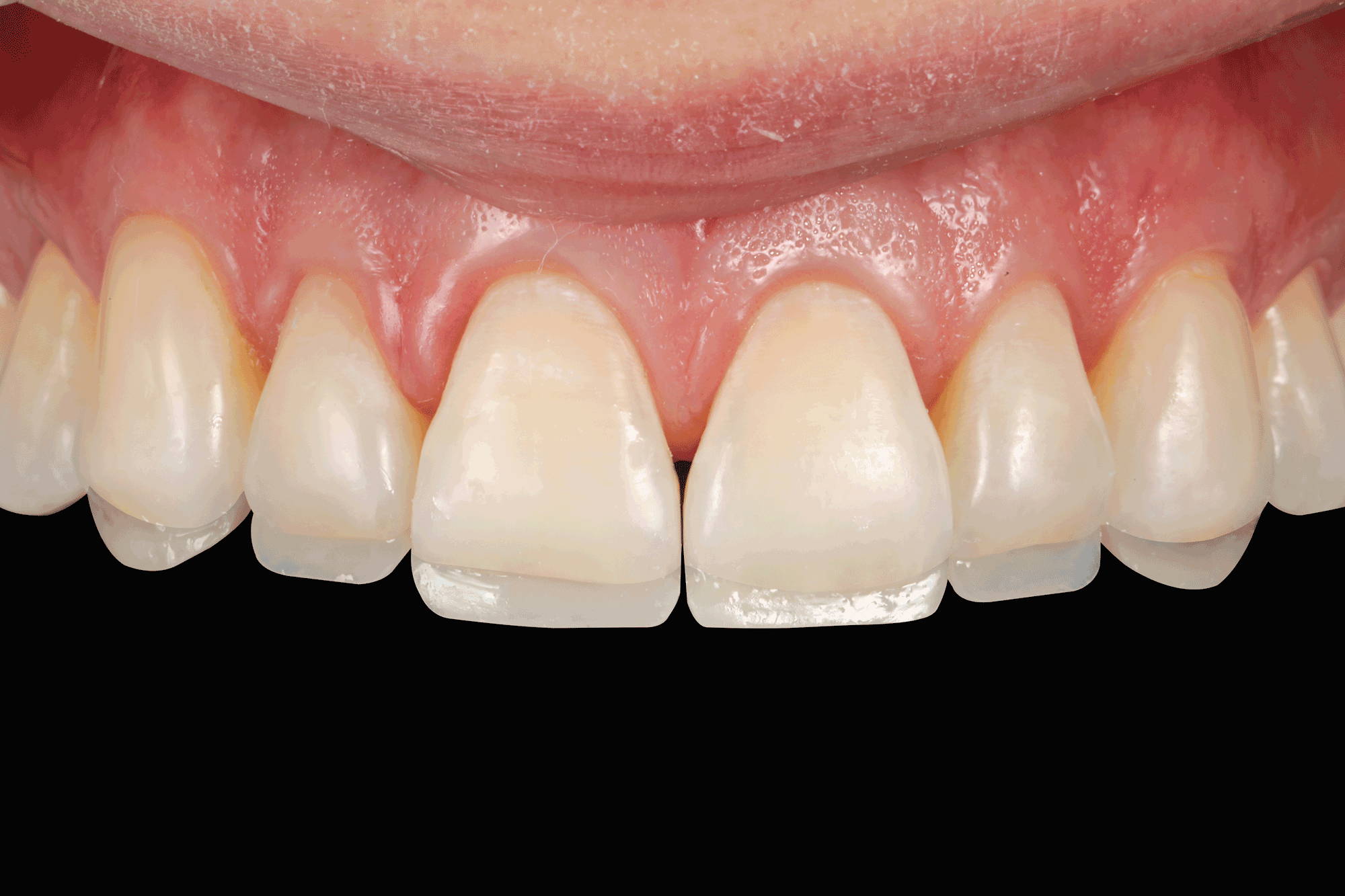 upper teeth with added composite layer