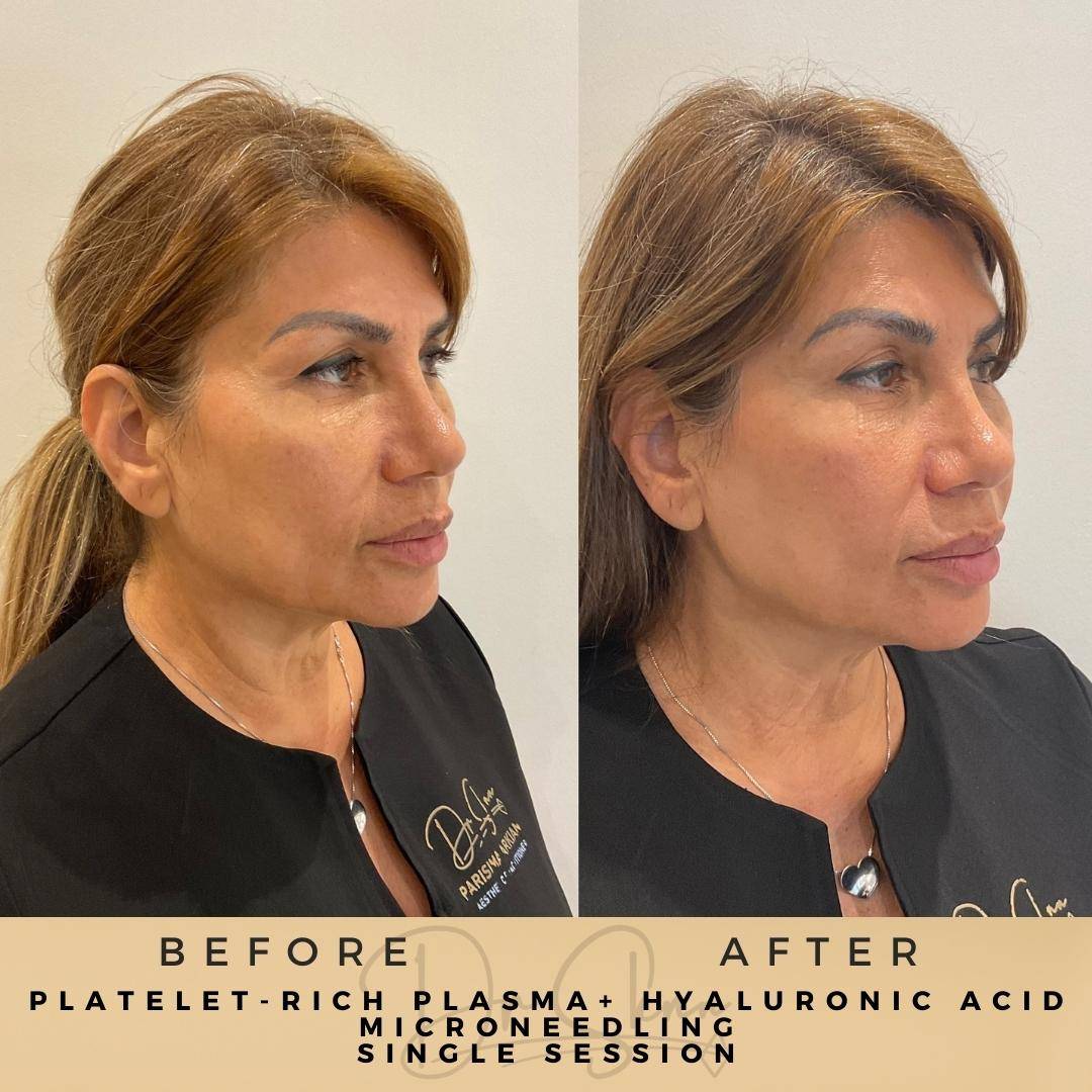 PRP Microneedling - Dr Sknn before and after