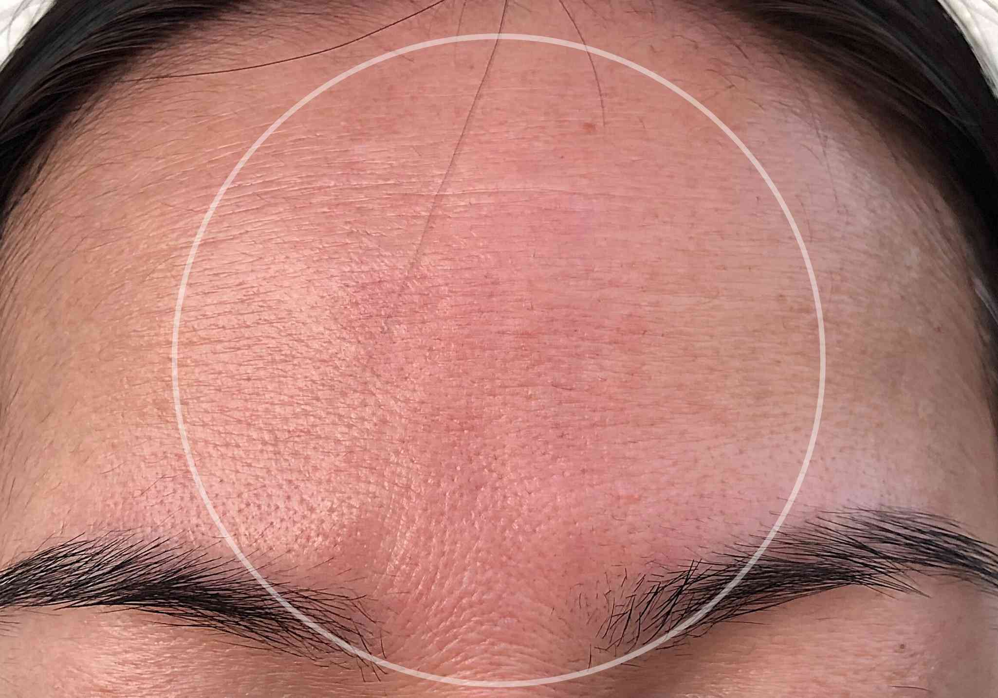 collagen-before-and-after-pictures-wrinkles-forehead-between-eyebrows