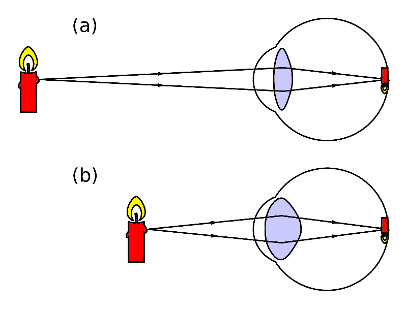 This Is How To Improve Near Vision After Cataract Surgery EyeMountain