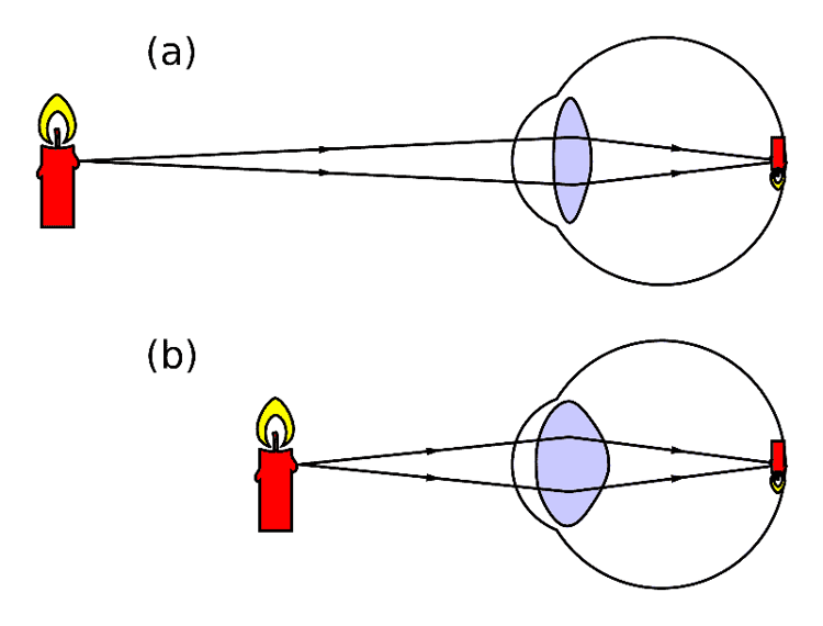 This Is How To Improve Near Vision After Cataract Surgery EyeMountain