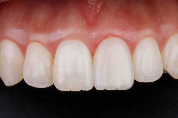 smooth teeth after restoration