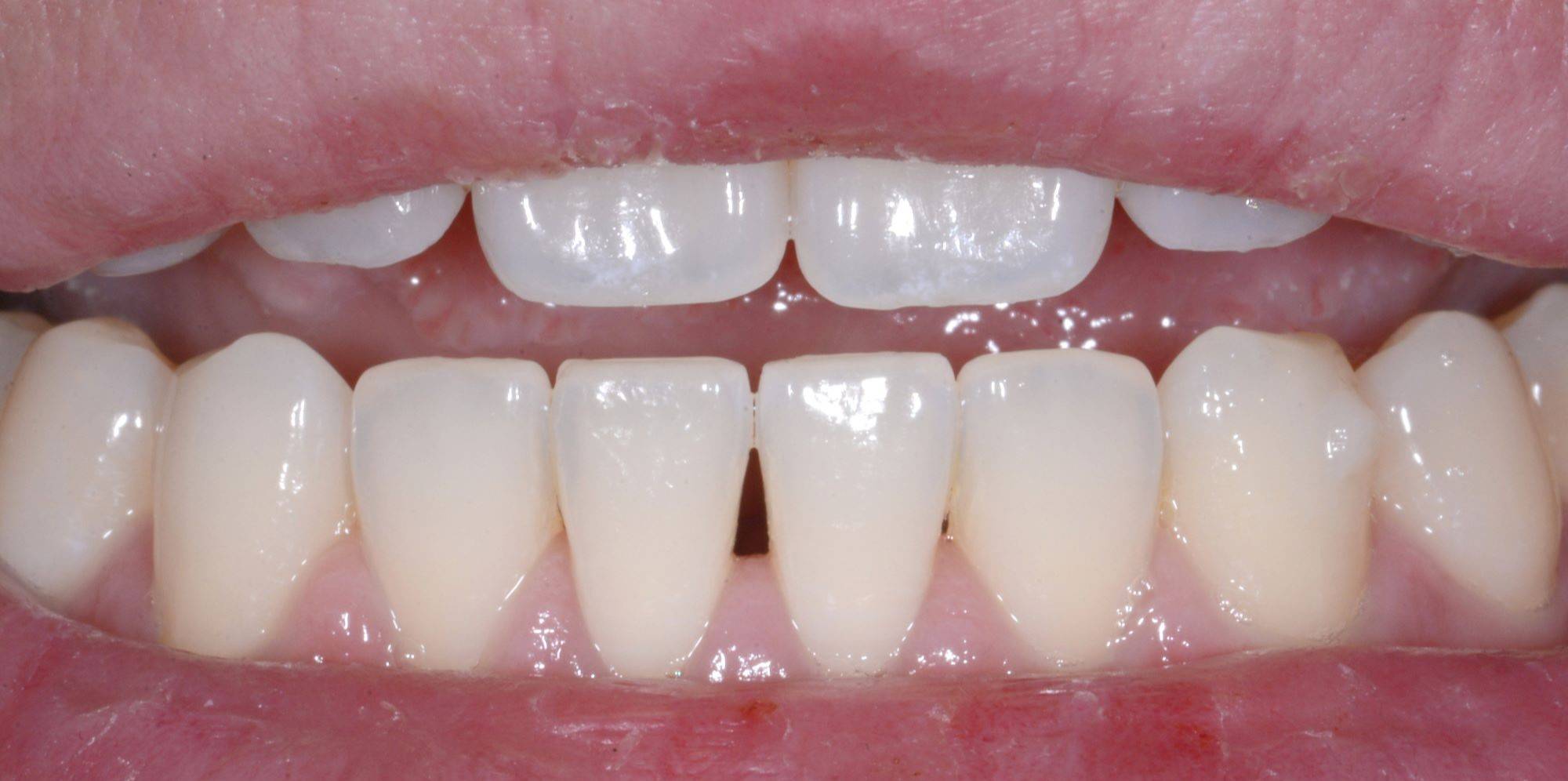 Close-up on smile showcasing small black triangle in lower central incisor