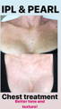 Woman's chest before and after IPL & Pearl Laser