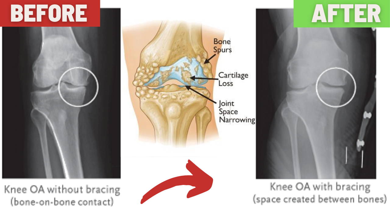 OA Unloader Knee Brace Support Lateral/Medial. Black with Built-in Hex Key  (L1851/L1843)